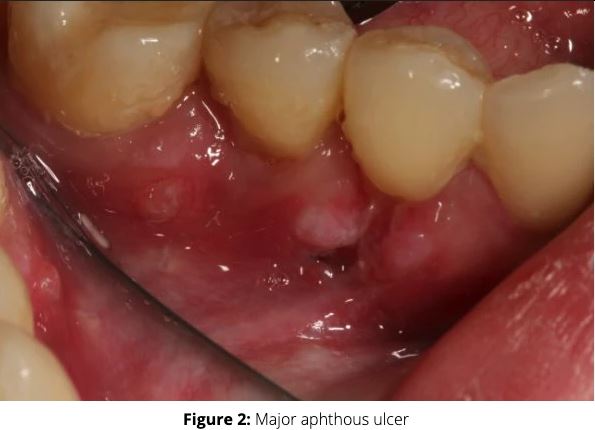 You are currently viewing Canker sores: An old enemy facing new treatment